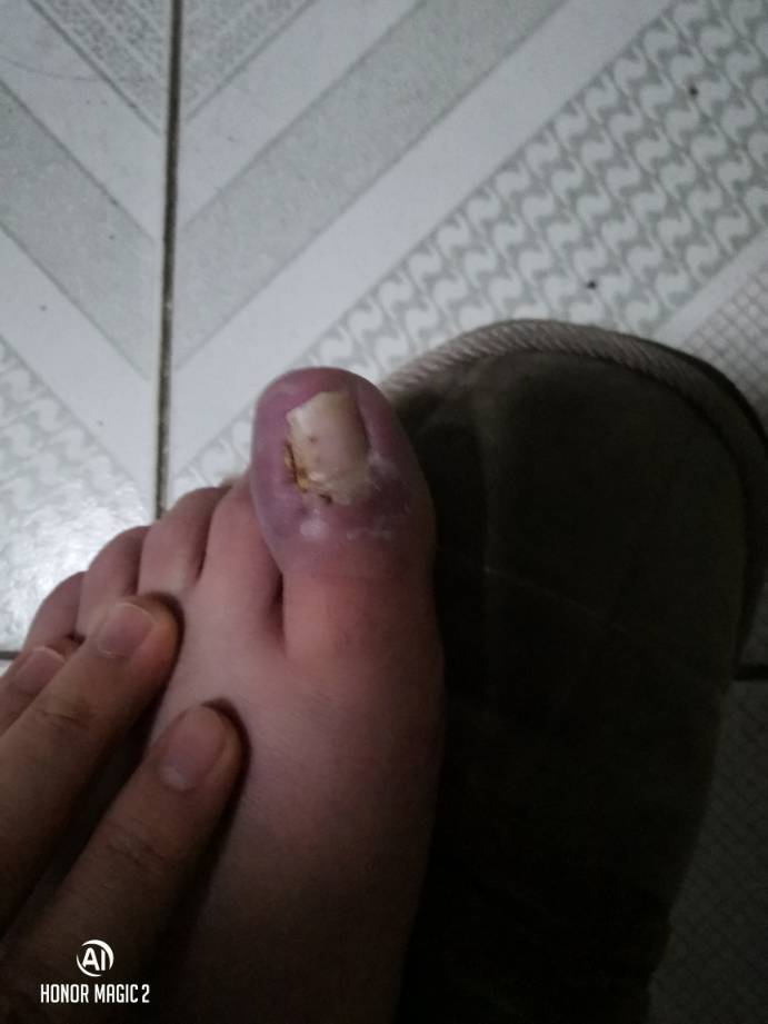 AG体育-灰熊JJJ正式接受脚趾手术三个月后重新评估的简单介绍